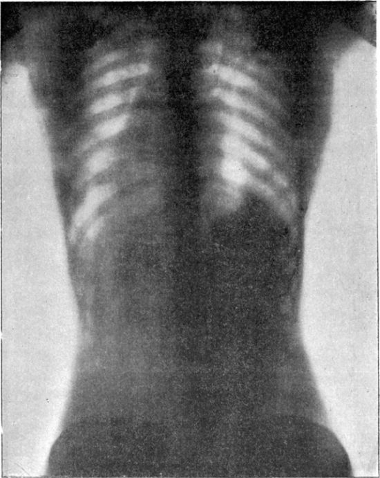 X-Rays Of Women Wearing Corsets (5 pics)