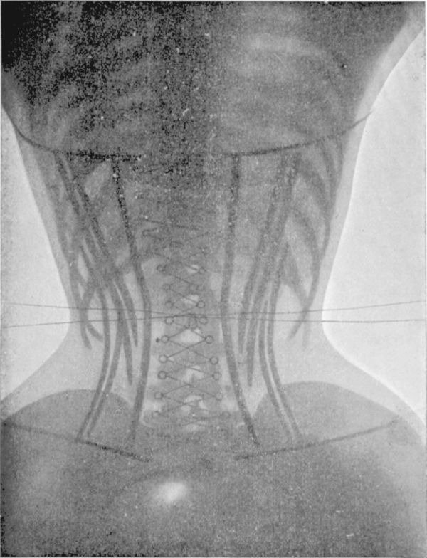 X-Rays Of Women Wearing Corsets (5 pics) X-Rays Of Women Wearing Corsets (5 pics)