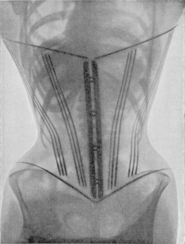 X-Rays Of Women Wearing Corsets (5 pics)
