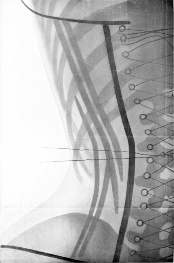 X-Rays Of Women Wearing Corsets (5 pics) X-Rays Of Women Wearing Corsets (5 pics)