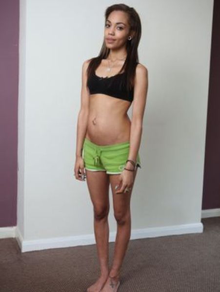 Anorexic Pregnant Girl (21 pics)
