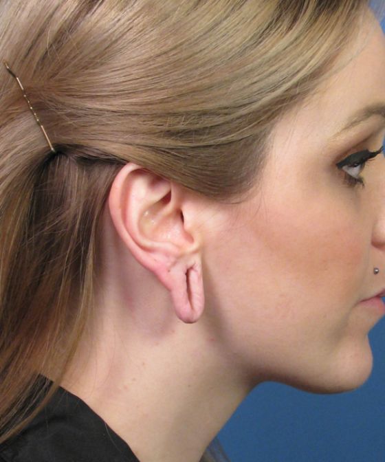 Gauged Ears Without The Gauges In (10 pics)