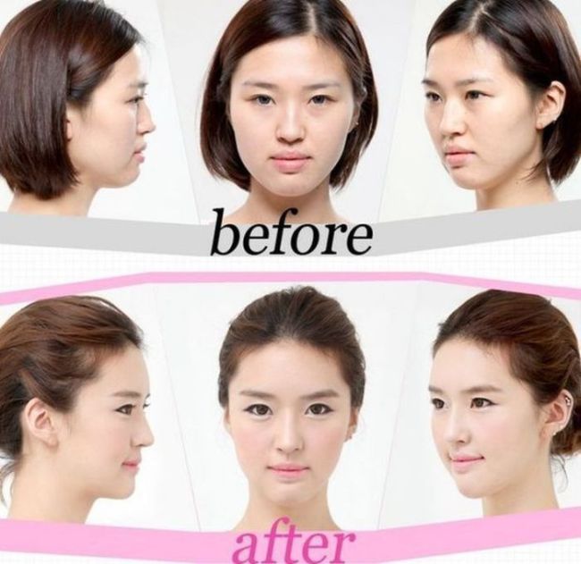 Before and After Plastic Surgery (29 pics)