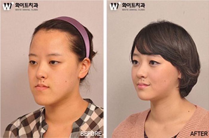 Before and After Plastic Surgery (29 pics)