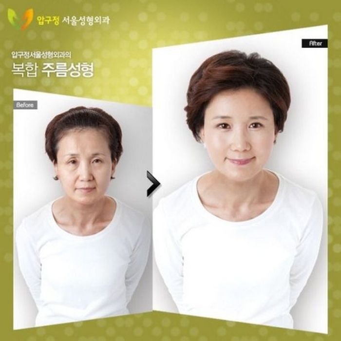 Before and After Plastic Surgery (29 pics)