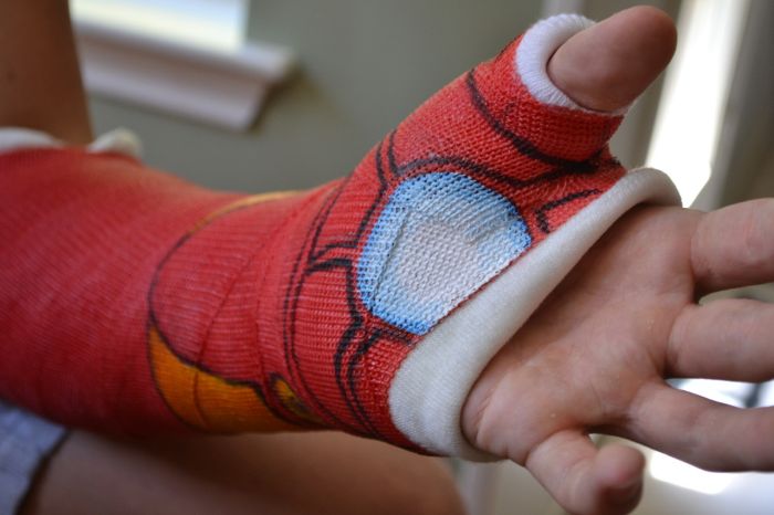 How to Wear a Cast in the Right Way (9 pics)