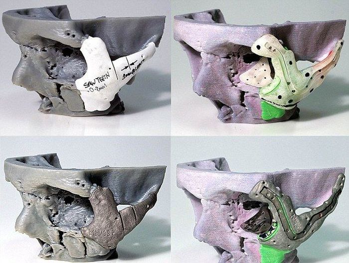 3D-Printed Skull for a Crash Victim (5 pics)
