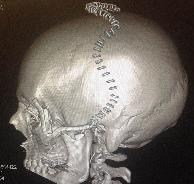 3D-Printed Skull for a Crash Victim (5 pics)