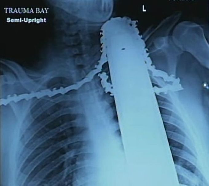 Chainsaw Stuck in Neck (6 pics)