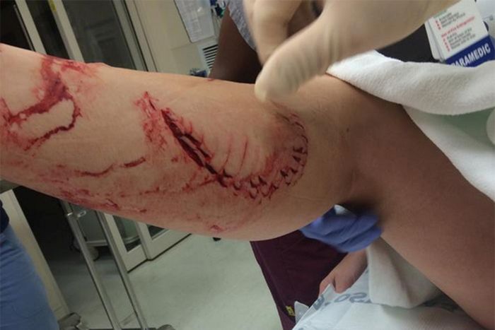 Florida Woman Bit By Shark, No Big Deal (5 pics)