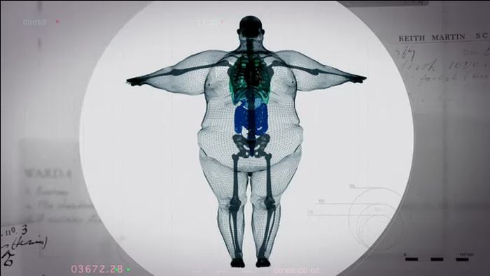 X-Ray Of A 980 Pound Man (5 pics)