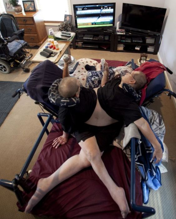 These Conjoined Twins Do Everything Together (11 pics)