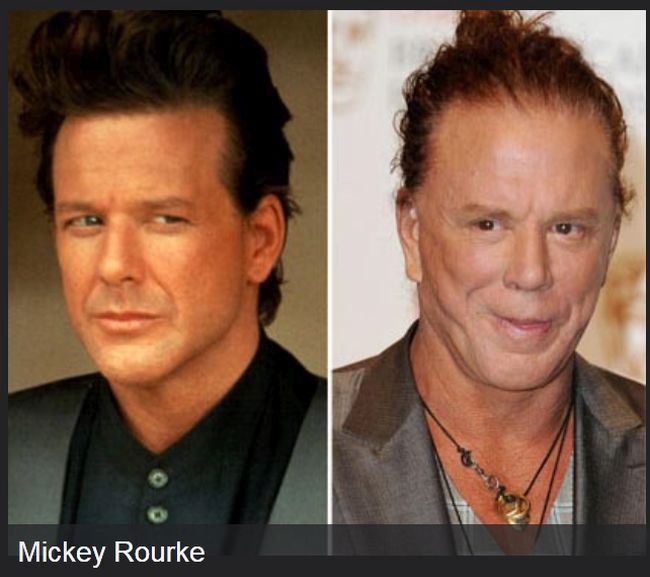 Celebrities Before And After Plastic Surgeries (22 pics)