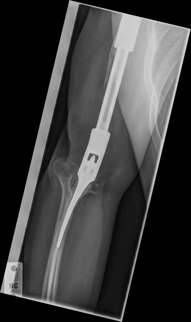 X-Ray Of A Metal Arm (4 pics)