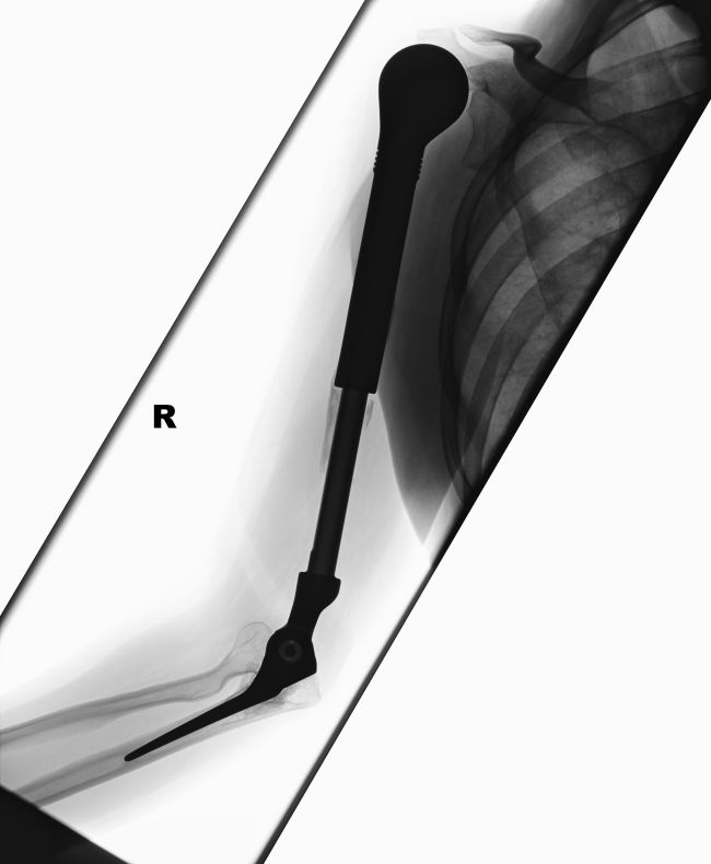 X-Ray Of A Metal Arm (4 pics)