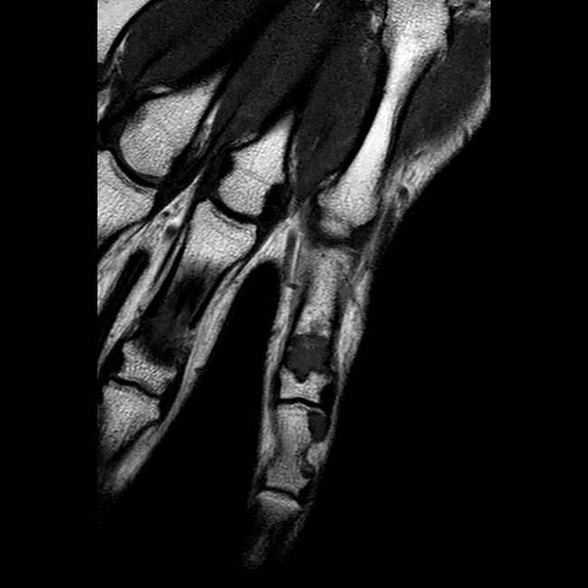 X-Ray Of A Metal Arm (4 pics)