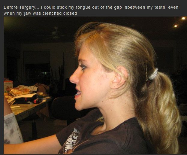 Life Changing Jaw Surgery (14 pics)