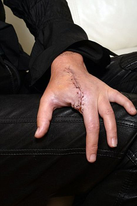 Finger Gets Amputated After A Spider Bite (5 pics)