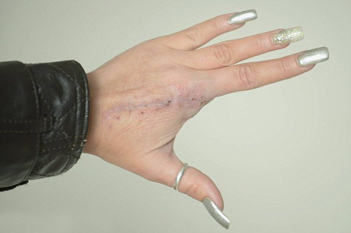 Finger Gets Amputated After A Spider Bite (5 pics)