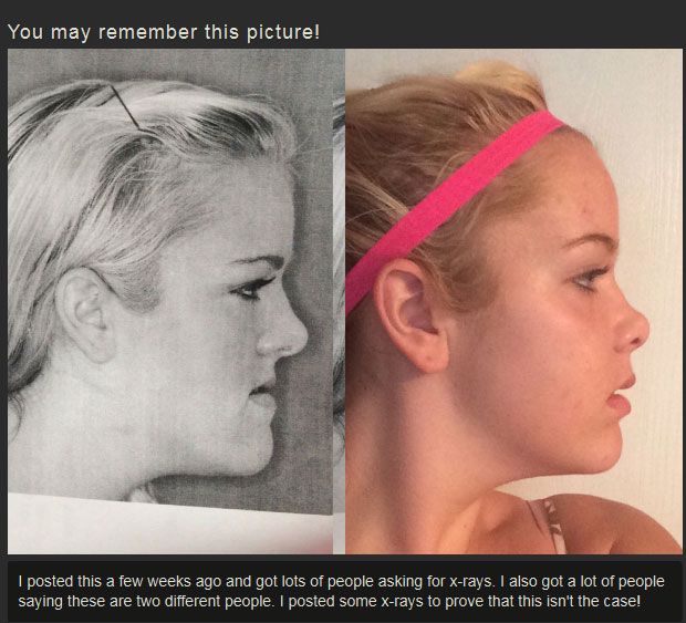 Before And After Jaw Surgery (12 pics)