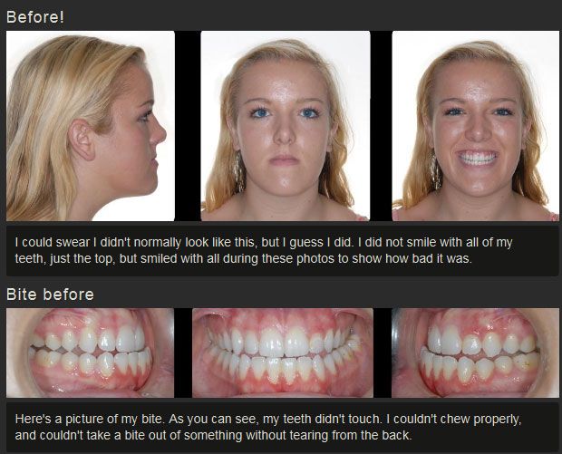 Before And After Jaw Surgery (12 pics)