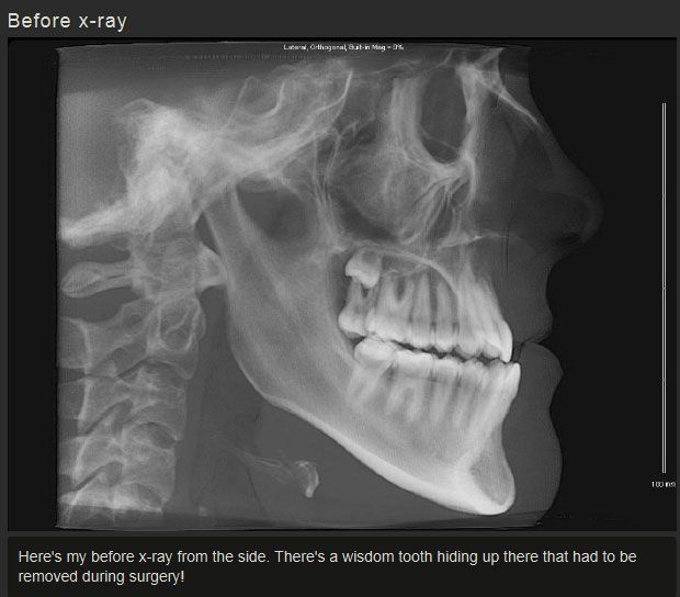 Before And After Jaw Surgery (12 pics)