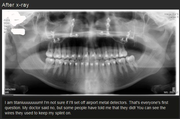 Before And After Jaw Surgery (12 pics)