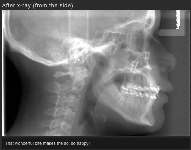 Before And After Jaw Surgery (12 pics)