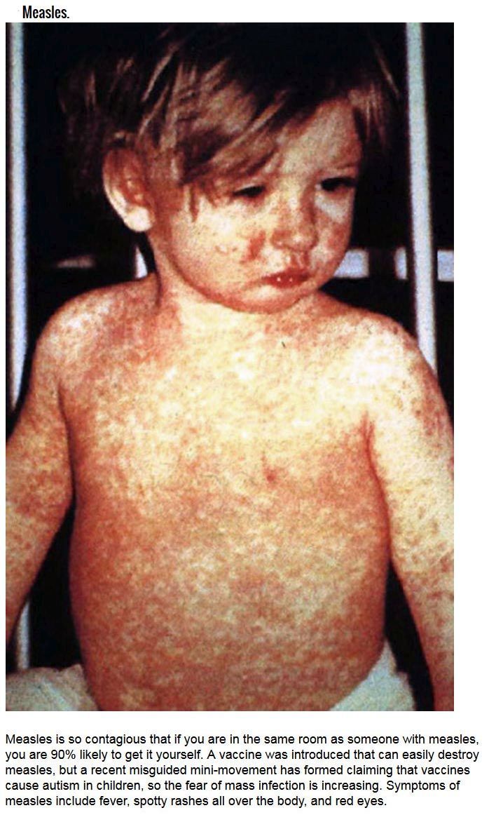 Deadly Diseases That Aren't Ebola (6 pics)