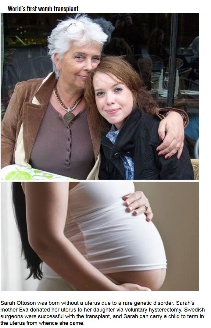 Strange Organ Transplant Stories From Around The World (10 pics)