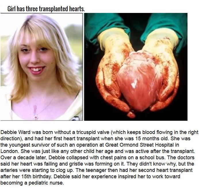 Strange Organ Transplant Stories From Around The World (10 pics)