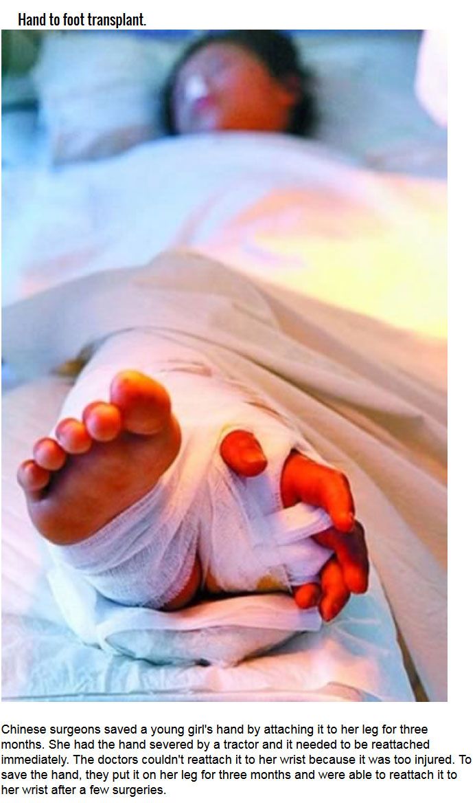 Strange Organ Transplant Stories From Around The World (10 pics)