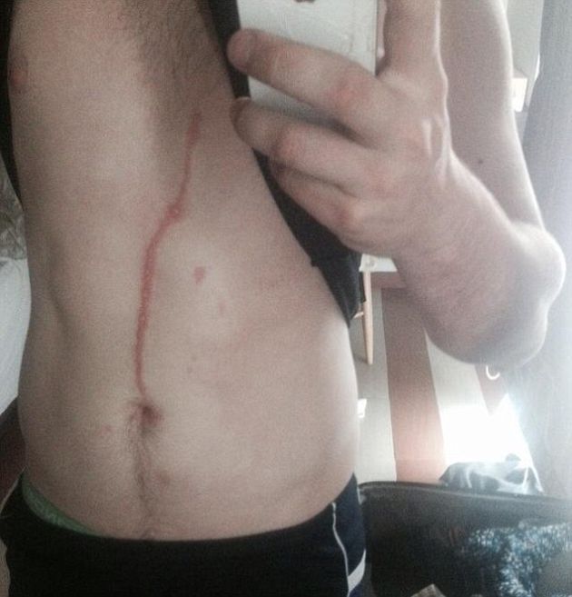 Man Gets Spider Pulled Out Of His Stomach (5 pics)
