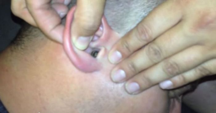 Man Has Something Terrible Stuck In His Ear (5 pics)