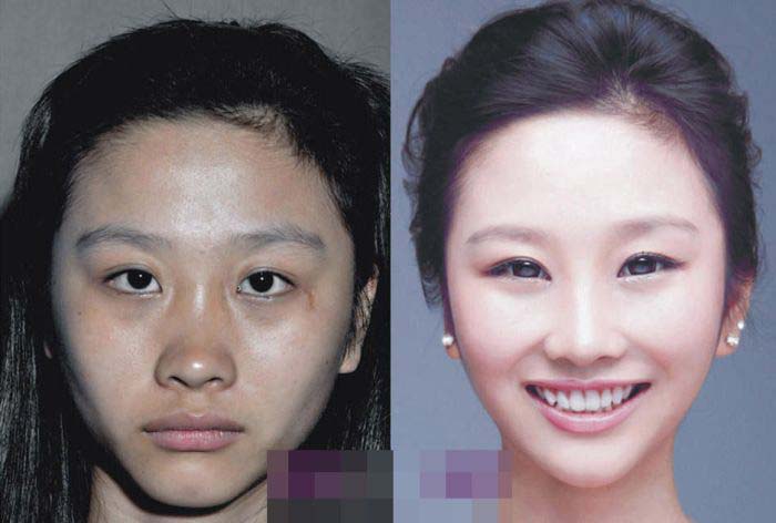 Plastic Surgery Is Popular In Asia (19 pics)