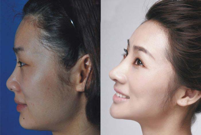 Plastic Surgery Is Popular In Asia (19 pics)