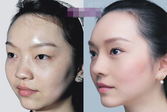 Plastic Surgery Is Popular In Asia (19 pics)