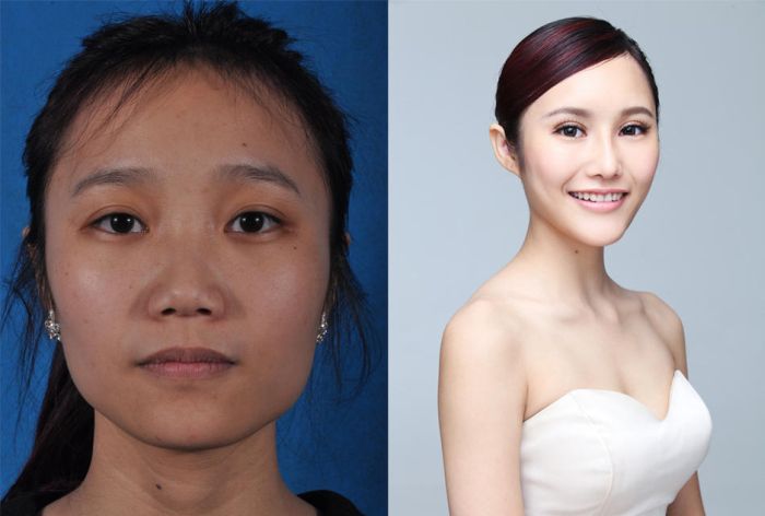 Plastic Surgery Is Popular In Asia (19 pics)