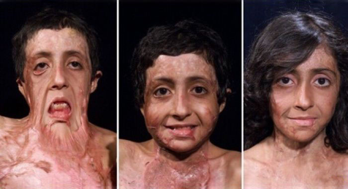 Burn Victim Gets Amazing Facial Reconstruction (4 pics)