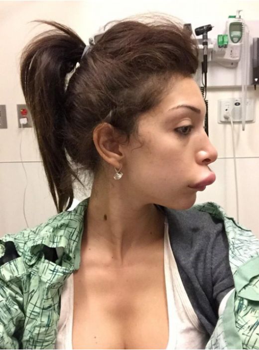 Farrah Abraham's Lip Implant Surgery Went Horribly Wrong (8 pics)