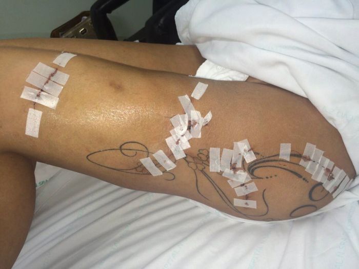 Miss Bumbum Andressa Urach Undergoes Surgery (9 pics)