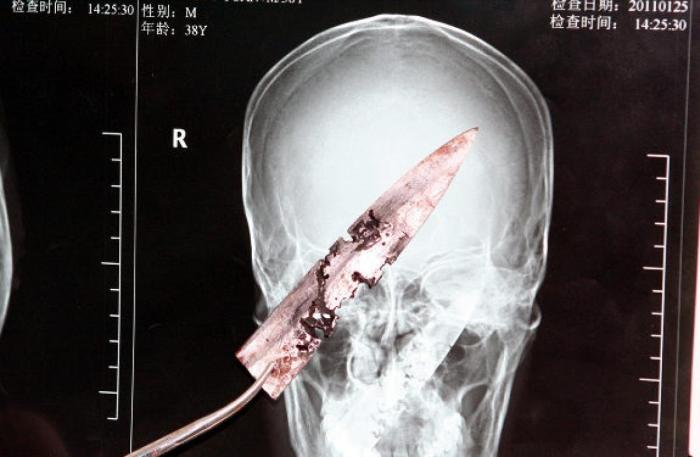 These Insane X-Rays Will Make You Wonder How That Got There (37 pics)