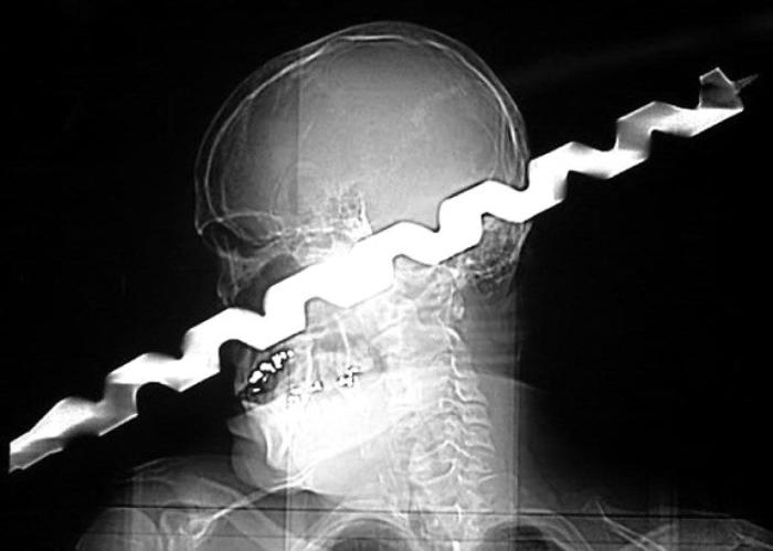 These Insane X-Rays Will Make You Wonder How That Got There (37 pics)