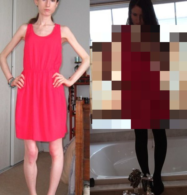 This Woman Is Looking Great After Recovering From An Eating Disorder (3 pics)