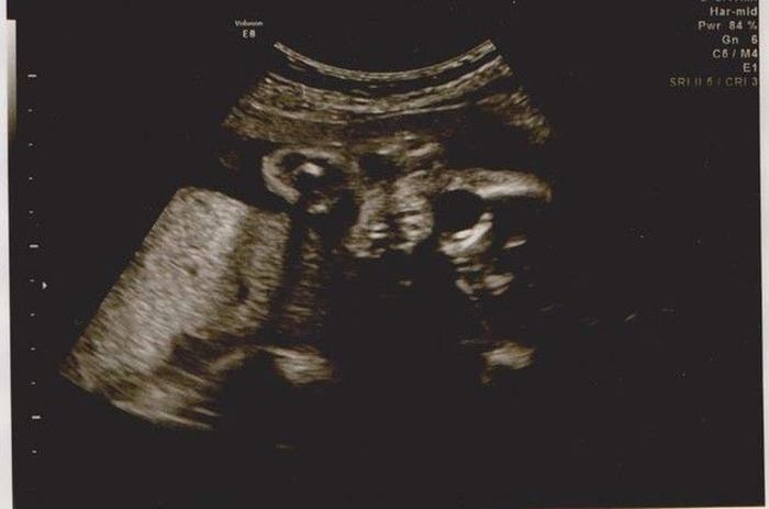 Ultrasounds That Look Like Nightmares Come To Life (13 pics)