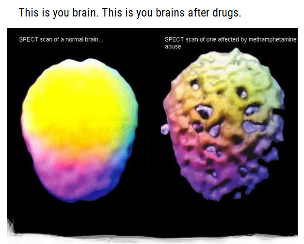 You Will Never Want To Do Drugs After Seeing These Photos (15 pics)