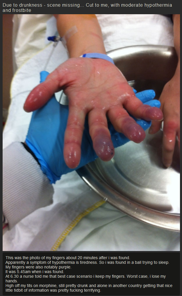 What Your Hands Look Like After They Get Frostbite (7 pics)
