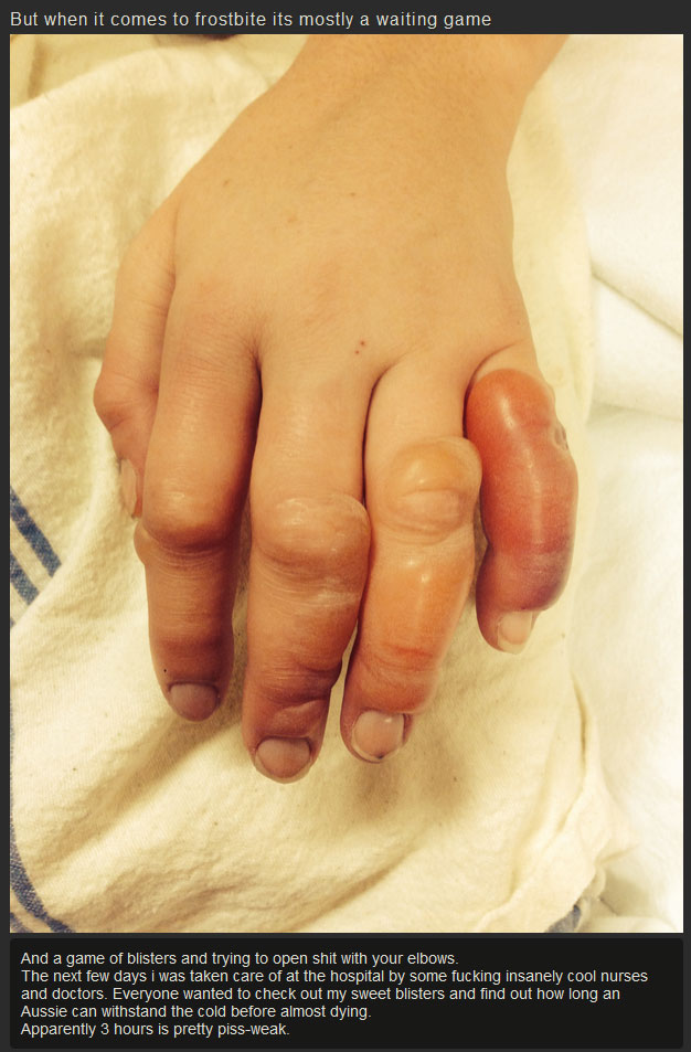What Your Hands Look Like After They Get Frostbite (7 pics)