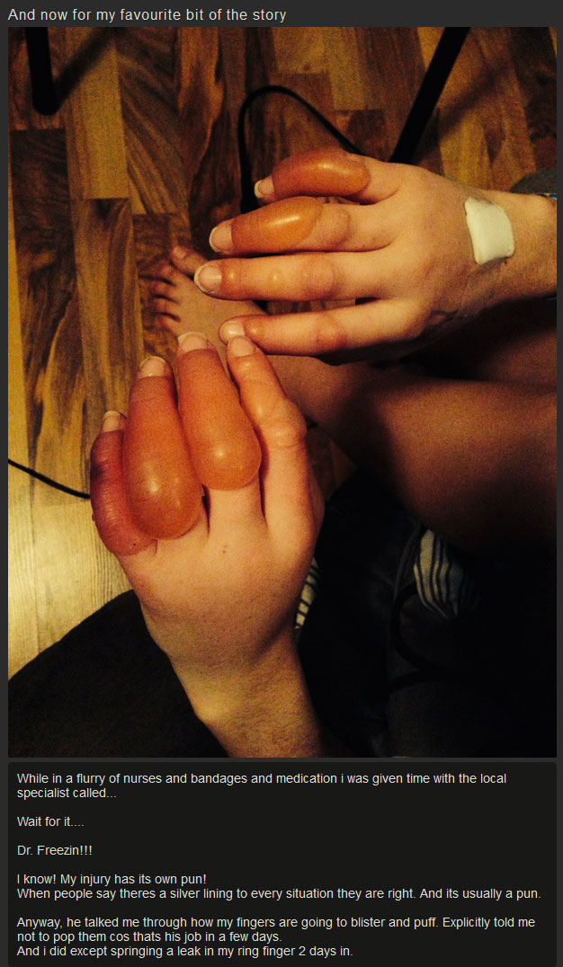 What Your Hands Look Like After They Get Frostbite (7 pics)