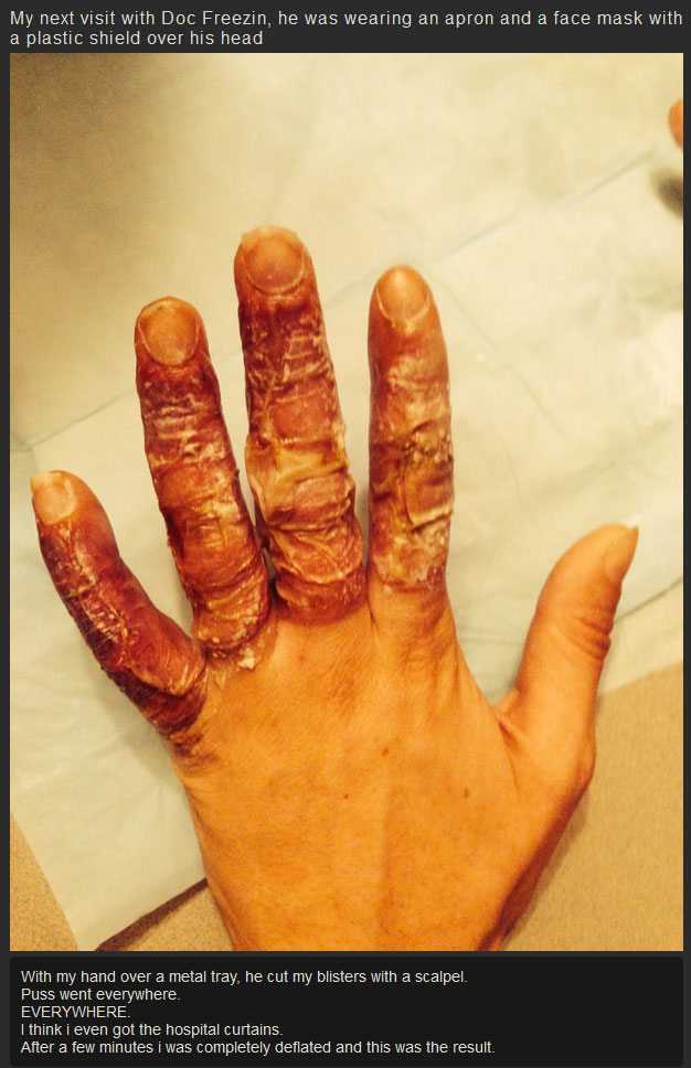 What Your Hands Look Like After They Get Frostbite (7 pics)